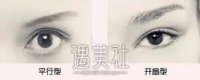 双眼皮平行扇形