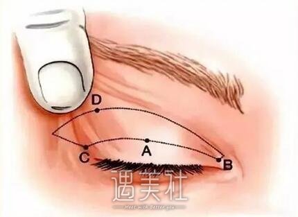 眼睑皮肤松弛矫正术