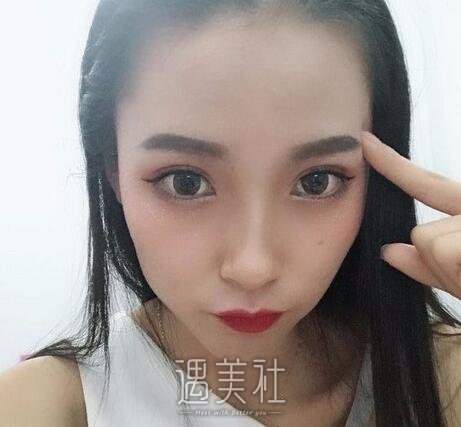 自体脂肪填充法令纹
