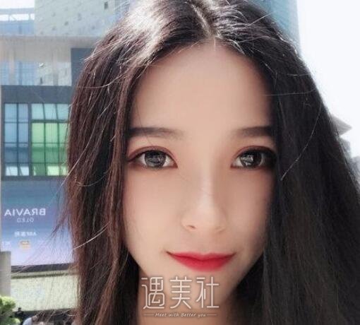 自体脂肪填充法令纹
