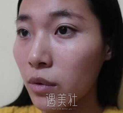 上海,九院,张盈帆,隆鼻