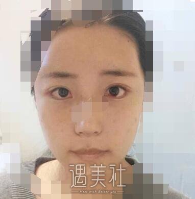 上海,九院,张盈帆,隆鼻