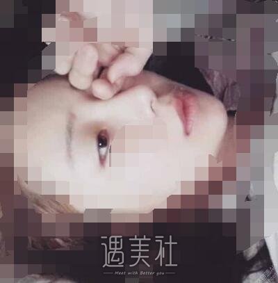 上海,九院,张盈帆,隆鼻