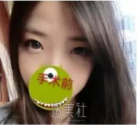 中日友好医院齐彦文双眼皮案例：水汪汪的大眼睛就是好看~ width=
