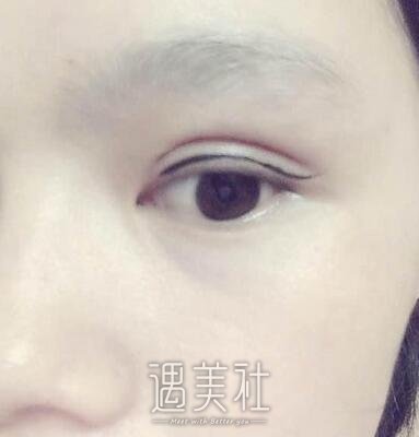 周一雄,双眼皮修复