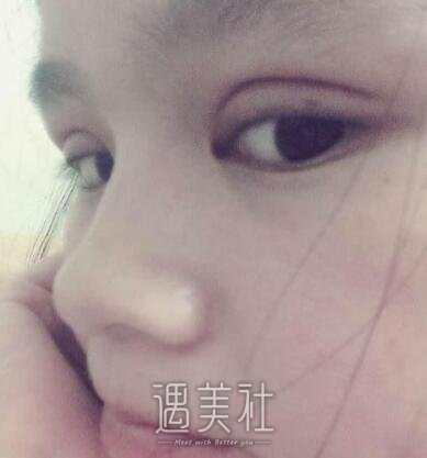 周一雄,双眼皮修复