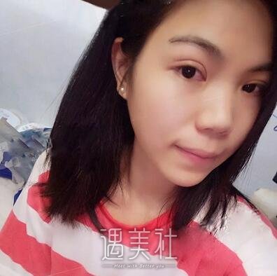 周一雄,双眼皮