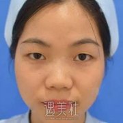 周一雄双眼皮案例：真是喜欢的不得了 width=