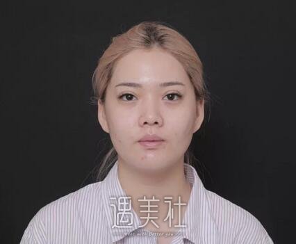 缪勇,隆鼻