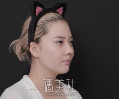 缪勇,隆鼻