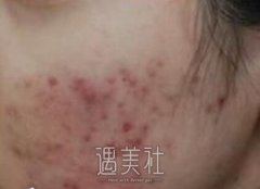 阎春林祛痘案例：痘印消失了，脸上特别光滑 width=