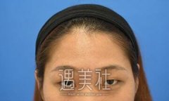 施悦双眼皮案例：果然和单眼皮不一样啊 width=
