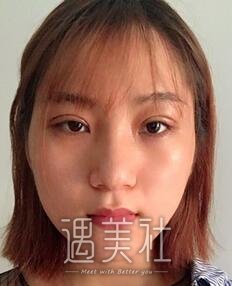 施悦,双眼皮