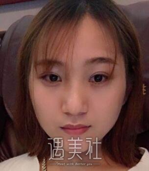 施悦,双眼皮