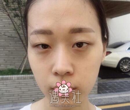 罗旭松,双眼皮修复