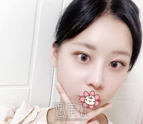 罗旭松,双眼皮修复