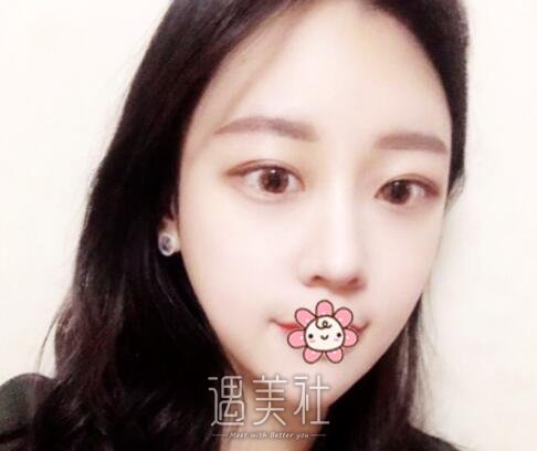 罗旭松,双眼皮修复