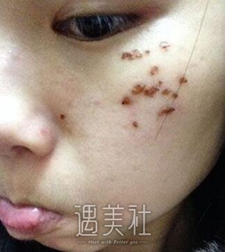 罗旭松,去痣