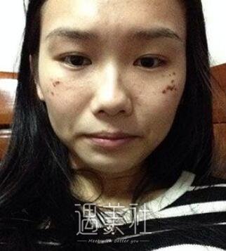 罗旭松,去痣