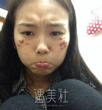 罗旭松,去痣