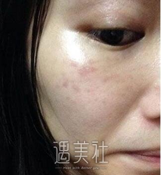 罗旭松,去痣