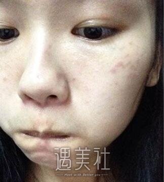罗旭松,去痣