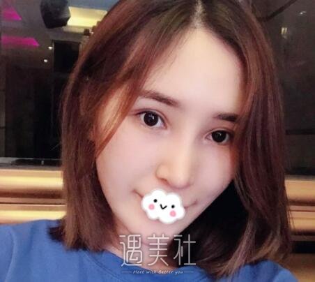 刘凯,隆鼻