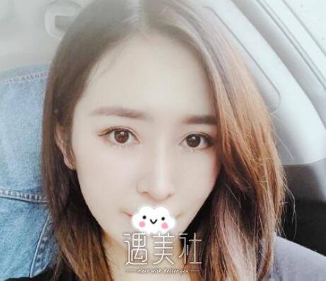 刘凯,隆鼻