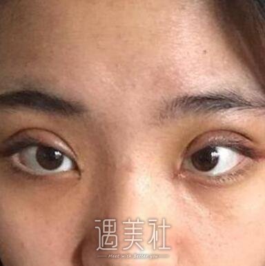 李圣利,双眼皮