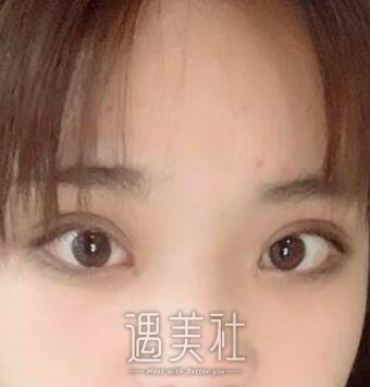 李圣利,双眼皮