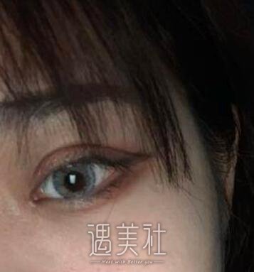 李圣利,双眼皮