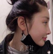 九院崔海燕隆鼻案例：看起来和天生的没啥两样～ width=