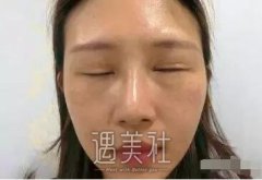 范巨峰做的双眼皮果好吗|范巨峰割双眼皮案例硬核力证~ width=