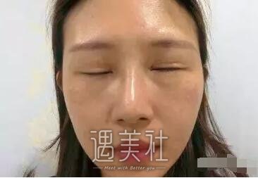 范巨峰做的双眼皮果好吗|范巨峰割双眼皮案例硬核力证~