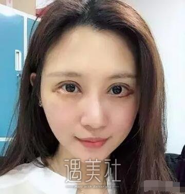 范巨峰做的双眼皮果好吗|范巨峰割双眼皮案例硬核力证~