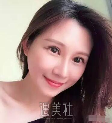 范巨峰做的双眼皮果好吗|范巨峰割双眼皮案例硬核力证~