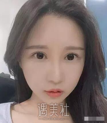 范巨峰做的双眼皮果好吗|范巨峰割双眼皮案例硬核力证~