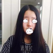 丽铂整形做了玻尿酸隆鼻，恢复果还是比预想的好一些~ width=