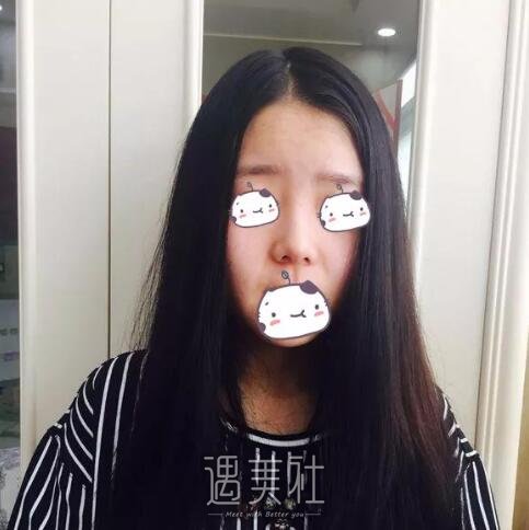 丽铂整形做了玻尿酸隆鼻，恢复果还是比预想的好一些~