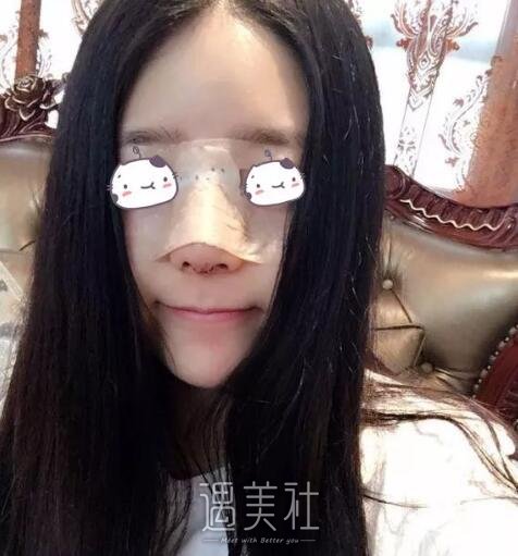 丽铂整形做了玻尿酸隆鼻，恢复果还是比预想的好一些~