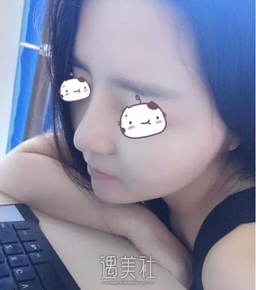 丽铂整形做了玻尿酸隆鼻，恢复果还是比预想的好一些~