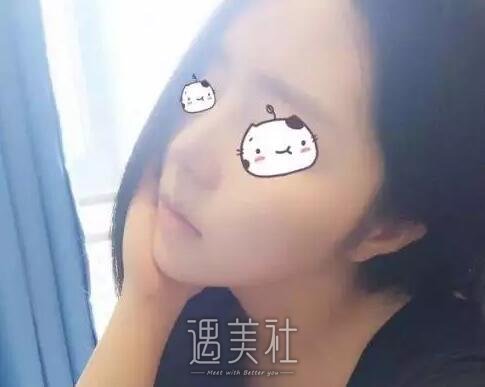 丽铂整形做了玻尿酸隆鼻，恢复果还是比预想的好一些~