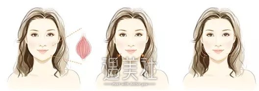 三亚做注射瘦脸整形大约多少钱?一般准备多少预算合适?