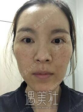 opt祛斑果究竟怎么样?opt祛斑真实案例恢复图片分享~