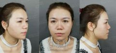 首尔丽格崔荣达颧弓内推手术案例：现在的“面相”很好~ width=