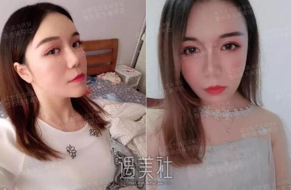 首尔丽格崔荣达颧弓内推手术案例：现在的“面相”很好~