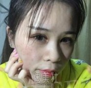 史三八整形医院做了激光祛斑后，出门都不用遮遮掩掩了~ width=