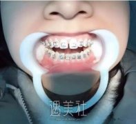 张一鸣正牙可信吗|跟着小编深入了解张一鸣正牙~ width=