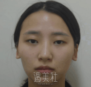 昆医整形做了开眼角+芭比双眼皮，和大家分享恢复果照片~ width=