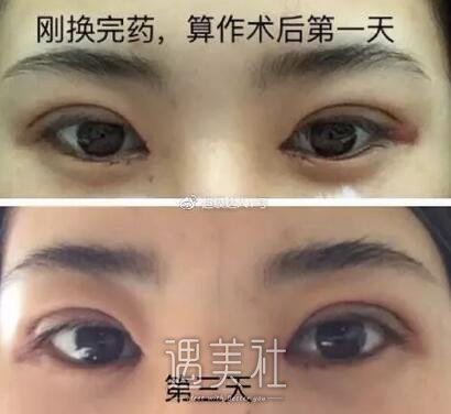 扇形双眼皮